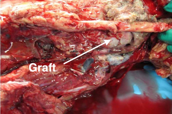 Popliteal Artery Graft 2